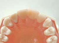 ウイングアタッチメントの入れ歯